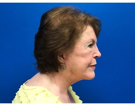 Facelift: Case 17 - After