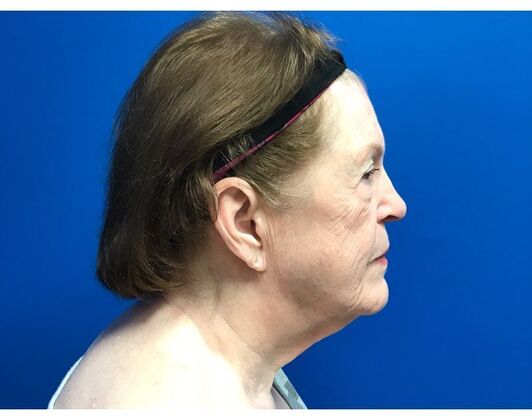 Facelift: Case 17 - Before