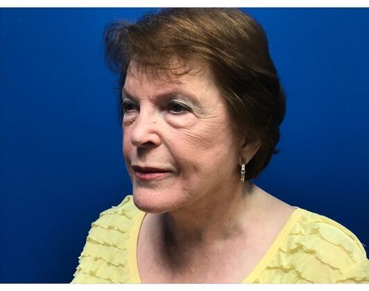 Facelift Case 17 - After