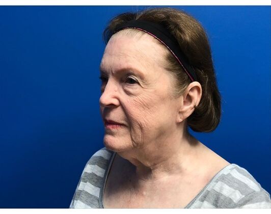 Facelift Case 17 - Before