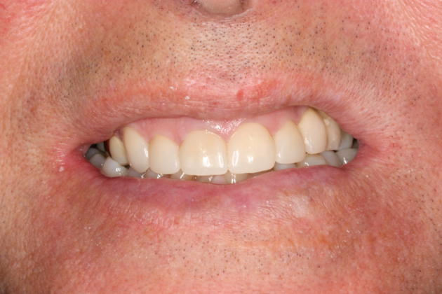 Porcelain Crowns and Veneers: HC-14499 - After