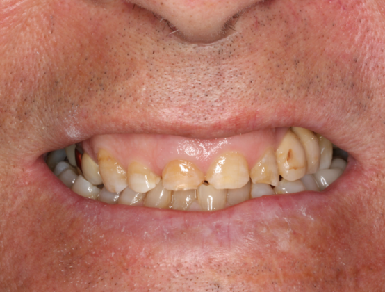 Porcelain Crowns and Veneers: HC-14499 - Before