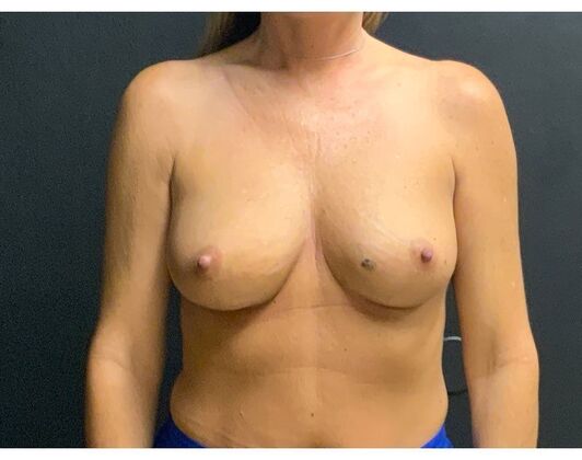Breast Augmentation Case 8 - Before