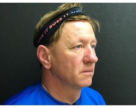 Blepharoplasty: Case 8 - Before