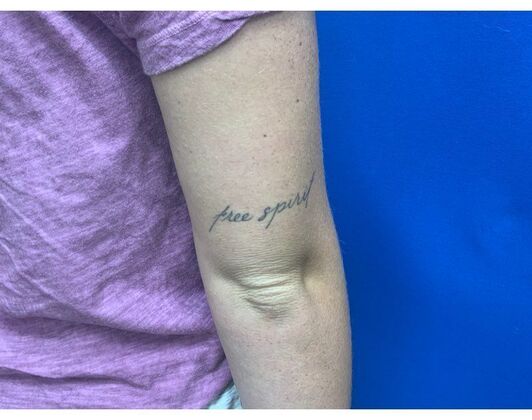 Laser Tattoo Removal  Case 4 - Before