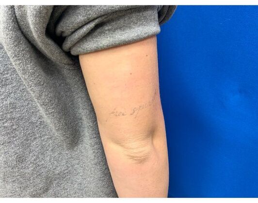 Laser Tattoo Removal  Case 4 - After