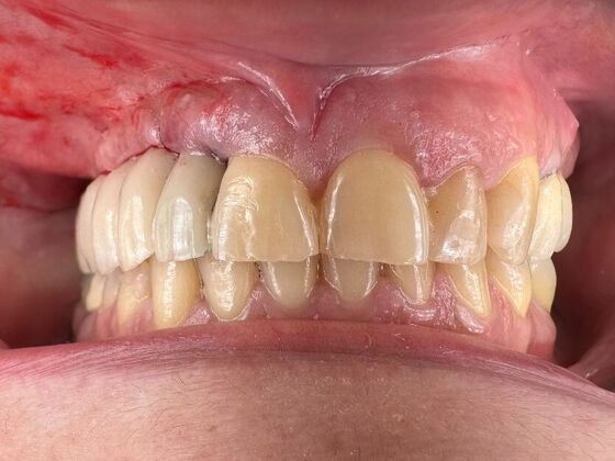 Dental Implants Case 1 - After
