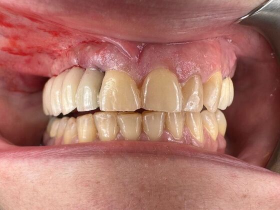 Dental Implants: Case 1 - After