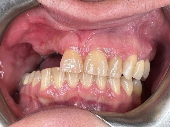Dental Implants: Case 1 - Before