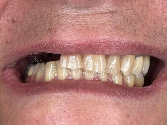 Dental Implants Case 1 - Before