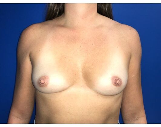 Breast Augmentation Case 35 - Before