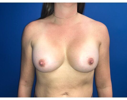 Breast Augmentation Case 35 - After