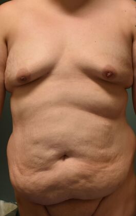 Mommy Makeover Case 243 - Before