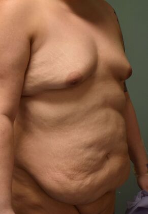 Mommy Makeover: Case 243 - Before