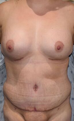 Massive Weight Loss : Case 107 - After