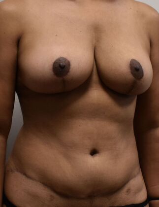 Mommy Makeover: Case 244 - After