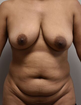 Mommy Makeover Case 244 - Before