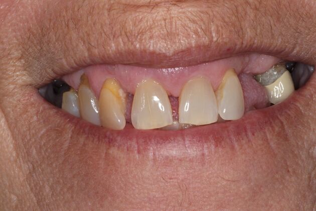 Teeth In A Day Case 28 - Before