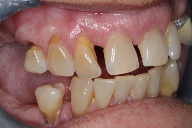 Teeth In A Day: Case 28 - Before