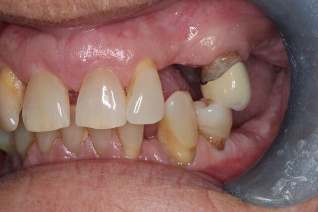 Teeth In A Day: Case 28 - Before