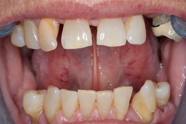 Teeth In A Day: Case 28 - Before
