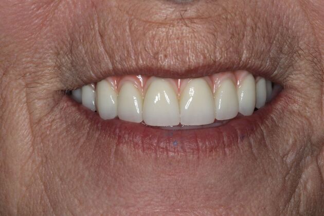 Teeth In A Day Case 28 - After