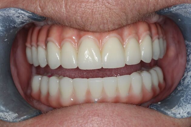 Teeth In A Day: Case 28 - After