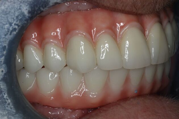 Teeth In A Day: Case 28 - upper and Lower All On 4