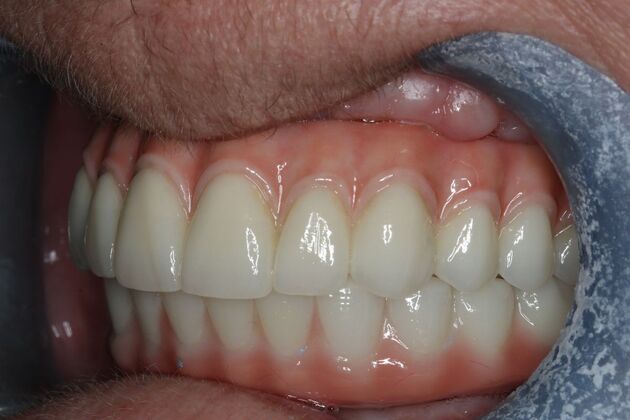 Teeth In A Day: Case 28 - upper and Lower All On 4
