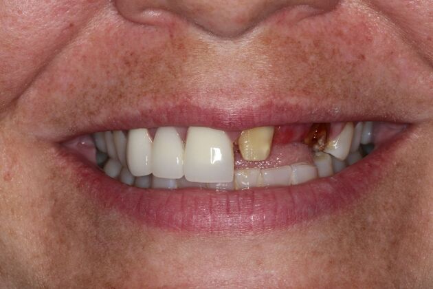 Dental Crowns Case 34 - Before