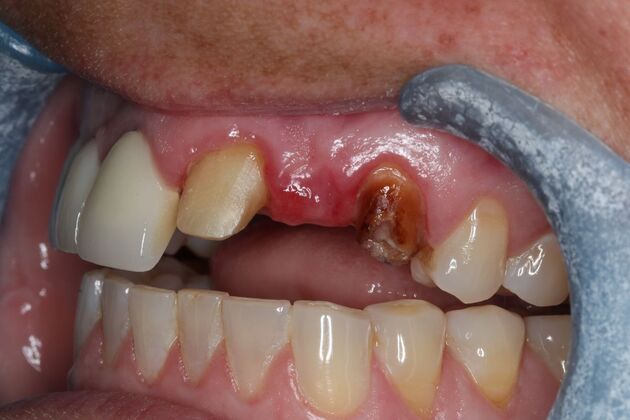 Dental Crowns: Case 34 - Before