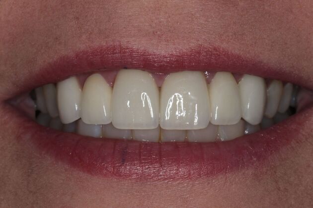 Dental Crowns Case 34 - After
