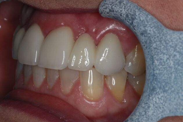 Dental Crowns: Case 34 - After