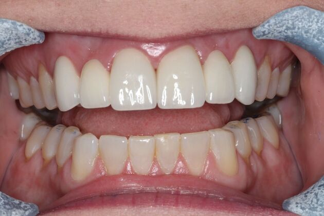 Dental Crowns: Case 34 - After