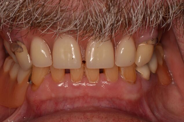 Hybrid Porcelain teeth on dental implants Case 1 - Before