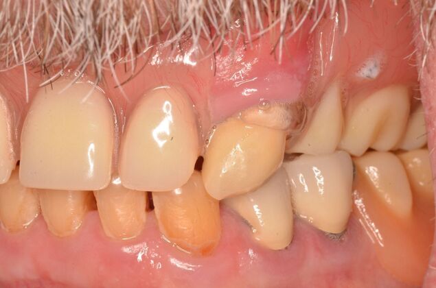 Hybrid Porcelain teeth on dental implants: Case 1 - Before
