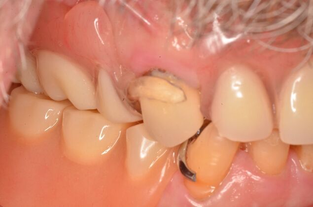 Hybrid Porcelain teeth on dental implants: Case 1 - Before