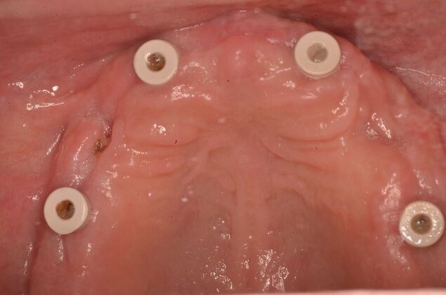 Hybrid Porcelain teeth on dental implants: Case 1 - Before