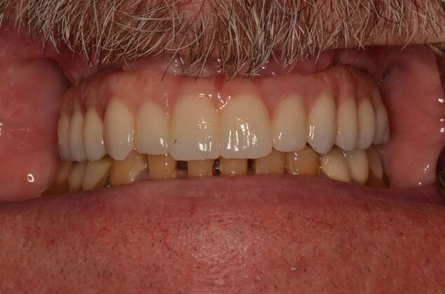 Hybrid Porcelain teeth on dental implants Case 1 - After
