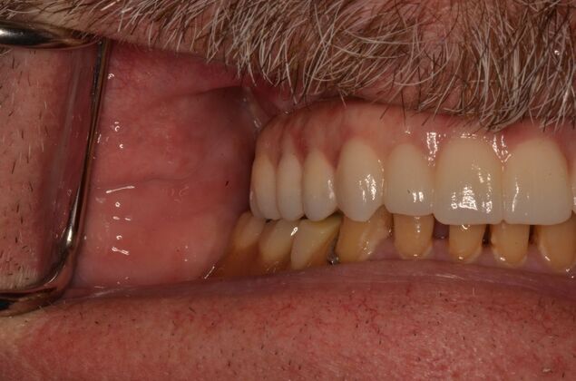 Hybrid Porcelain teeth on dental implants: Case 1 - After