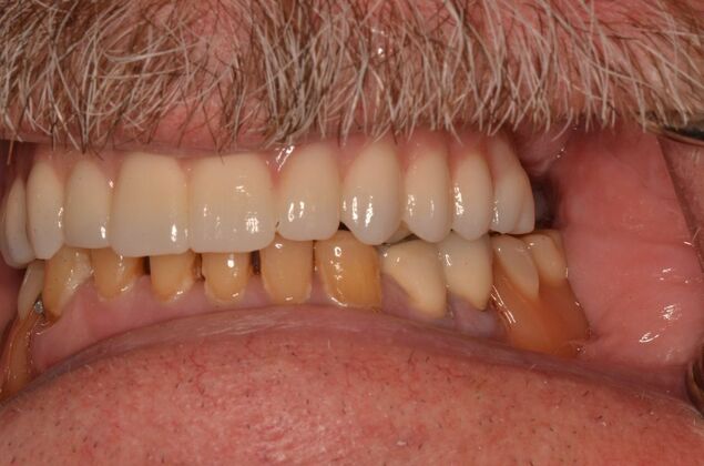 Hybrid Porcelain teeth on dental implants: Case 1 - After