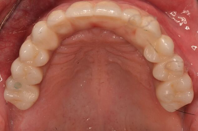 Hybrid Porcelain teeth on dental implants: Case 1 - After