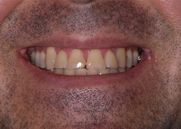 Cosmetic Crowns Case 9 - Before