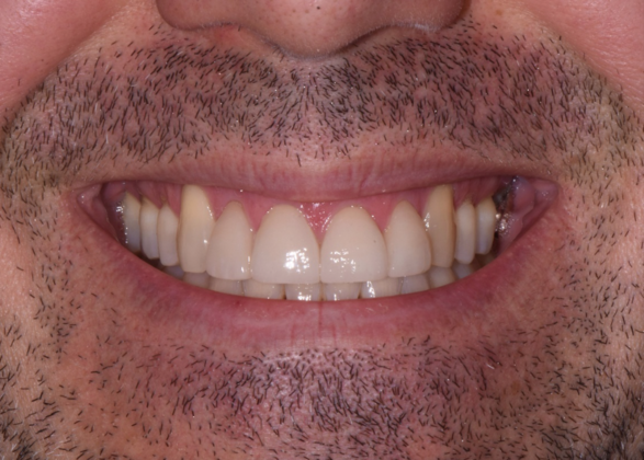 Cosmetic Crowns Case 9 - After