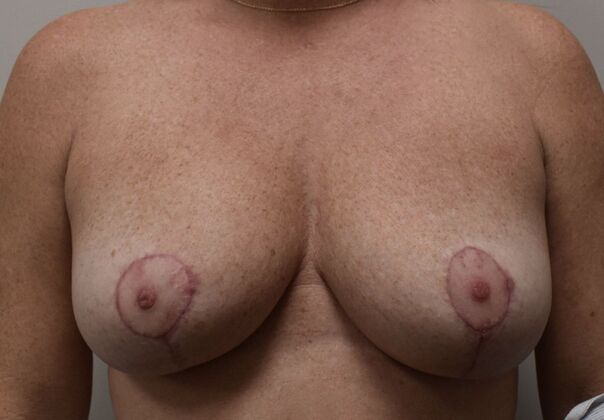 Breast Implant Removal: Case 19 - After