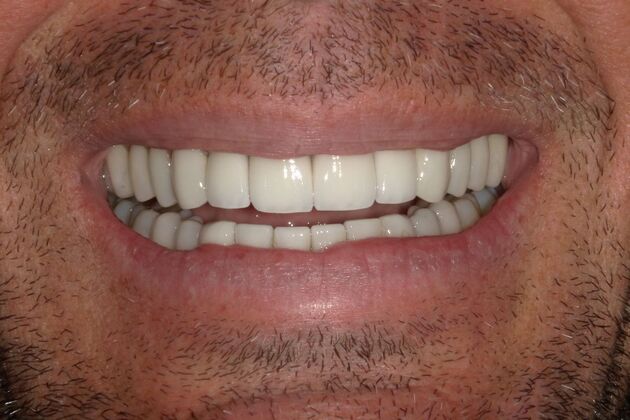 Full Mouth Reconstruction: Case 20 - After