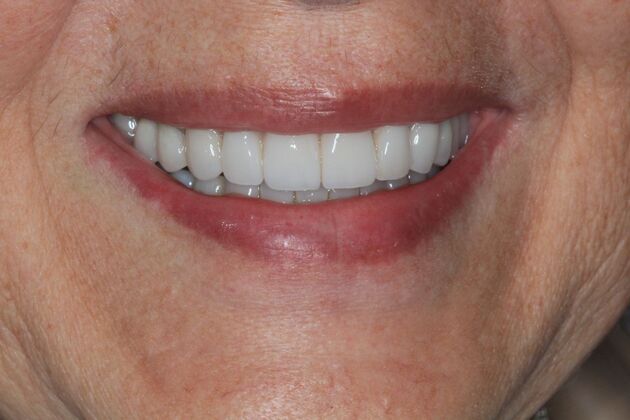 Full Mouth Reconstruction: Case 31 - After