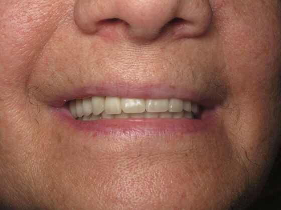 Teeth in a Day: Twenty Years Younger Overnight! - After