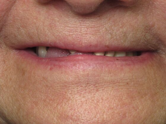 Teeth in a Day: Twenty Years Younger Overnight! - Before