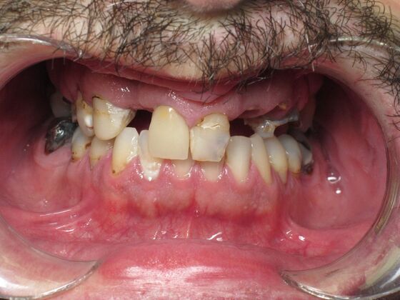 Teeth in a Day: Broken Teeth Solved - Before